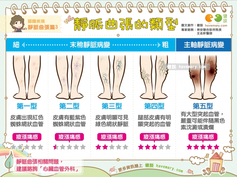 靜脈曲張,靜脈曲張的類型,靜脈曲張種類,健康圖文,健康漫畫,漫漫健康,Varicose veins, type of varicose veins,健談,健談網,havemary